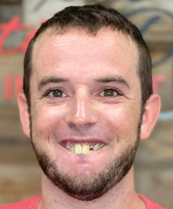 Before: original smile