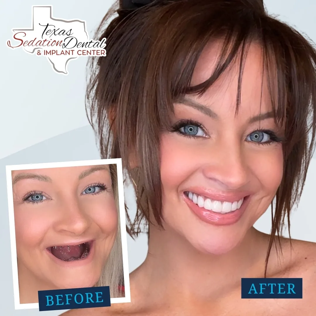 23 Extractions and Zero Regrets: How I Reclaimed My Smile