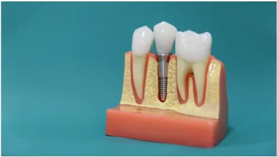 Dental Implants 