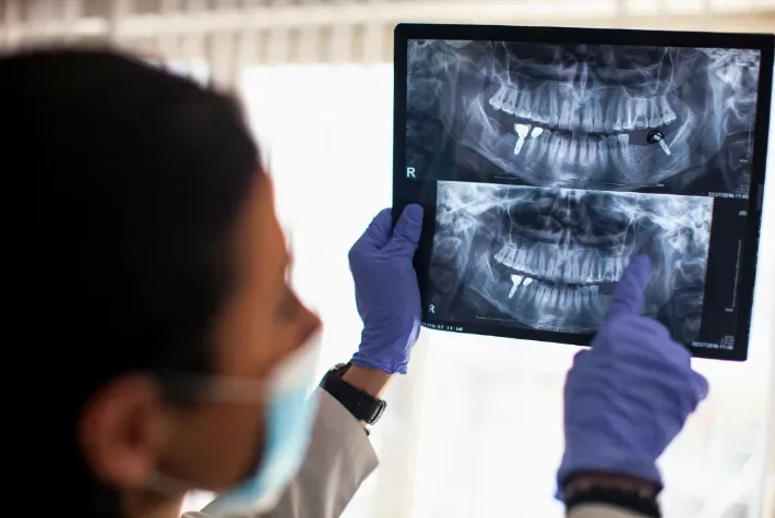 Do I Need A Bone Graft?