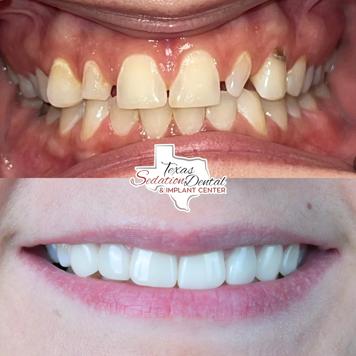 Patient before and after smile transformation