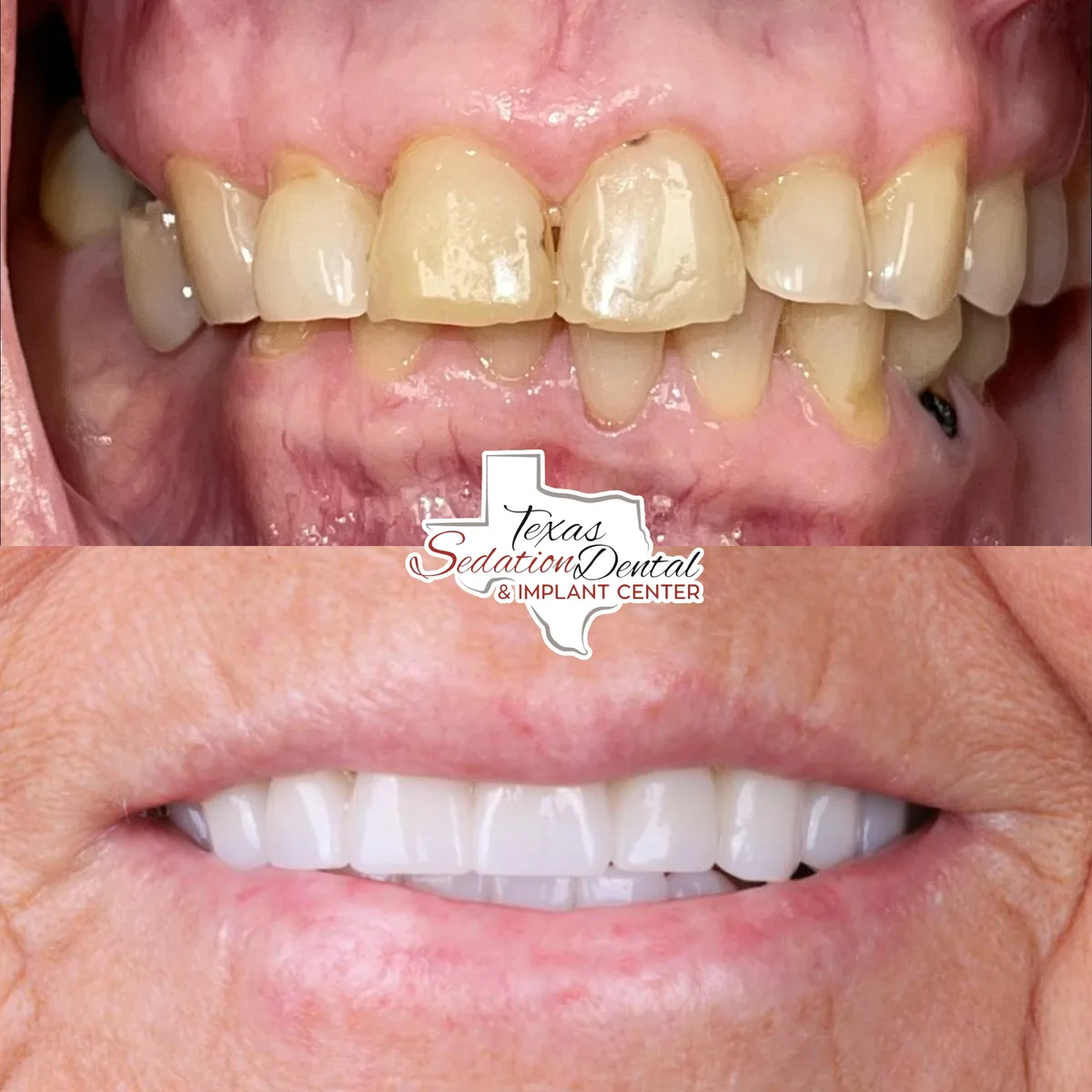 Patient before and after smile transformation