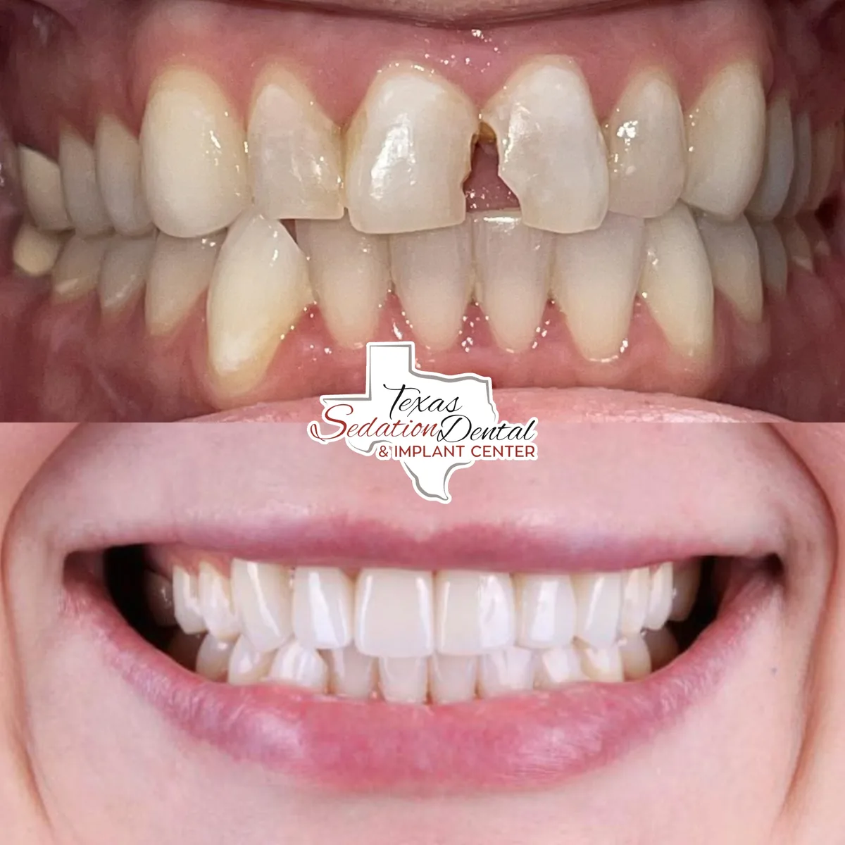 Patient before and after smile transformation