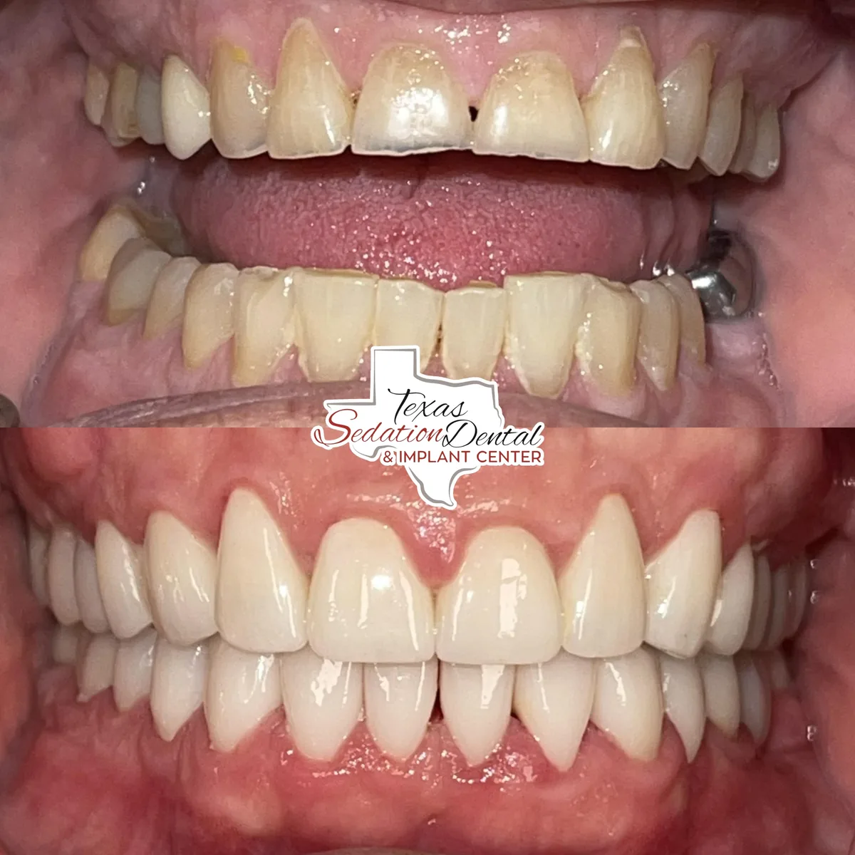 Patient before and after smile transformation