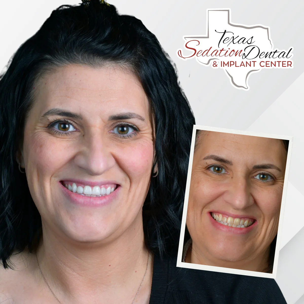 Patient before and after smile transformation