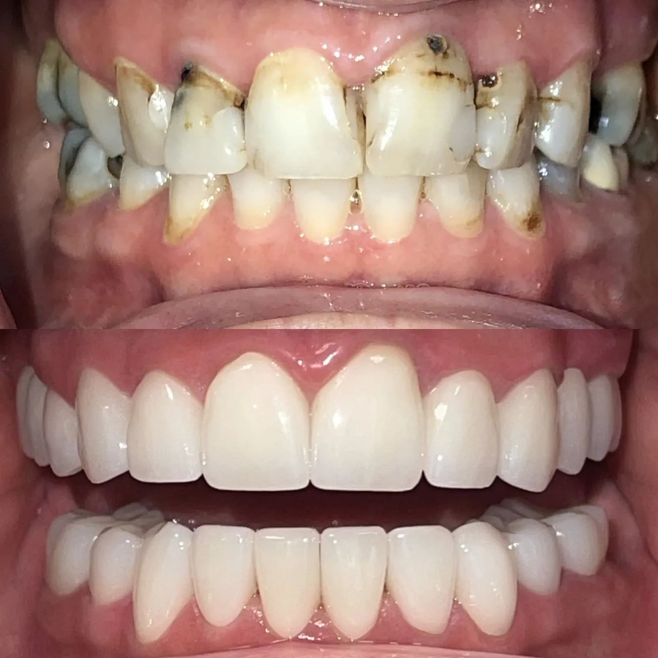 Before and after full mouth dental restoration showing dramatic smile transformation