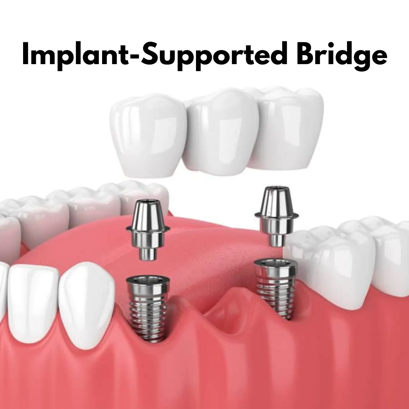 Implant-supported dental bridge diagram showing crowns secured to titanium implants