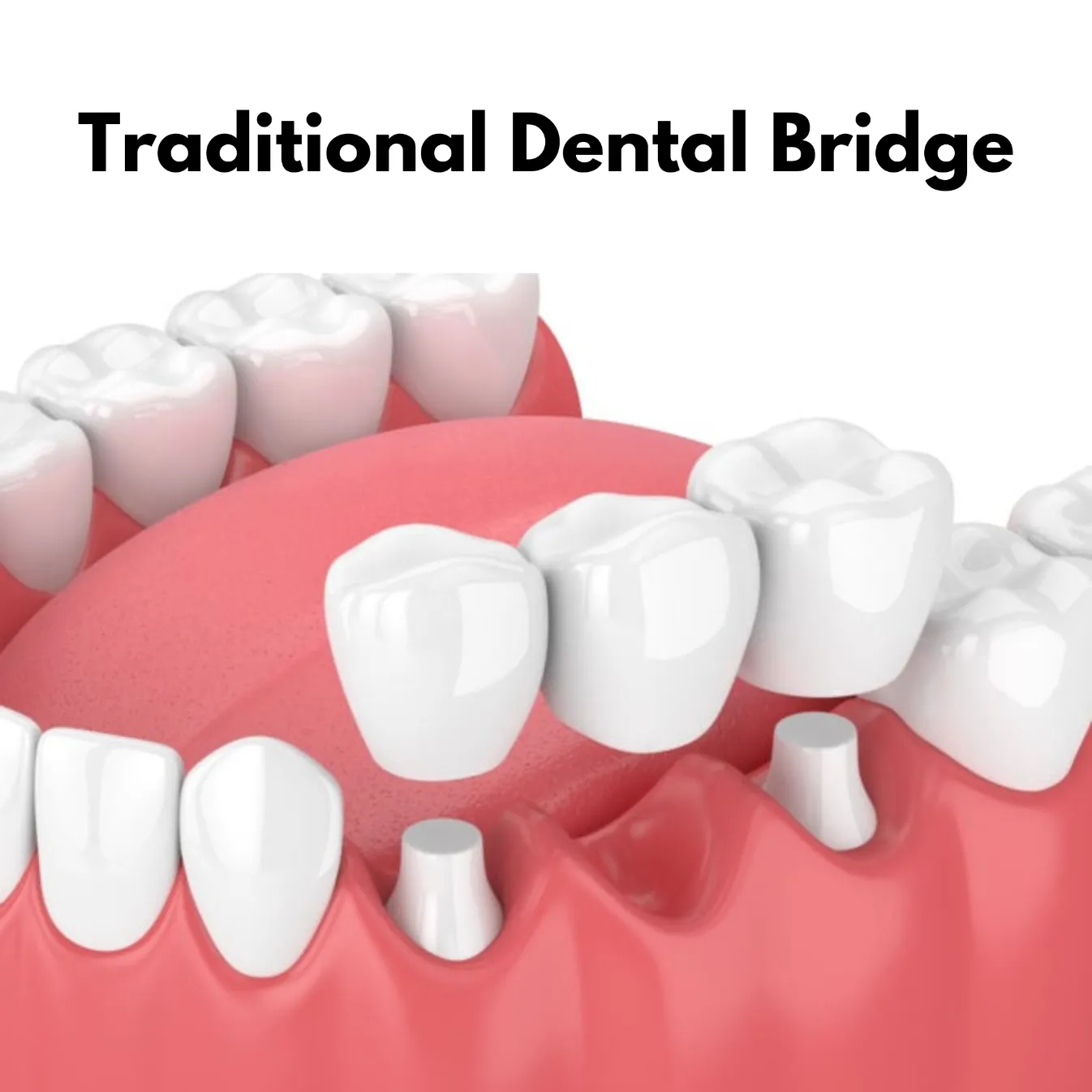 Traditional dental bridge illustration showing crowns supported by adjacent natural teeth