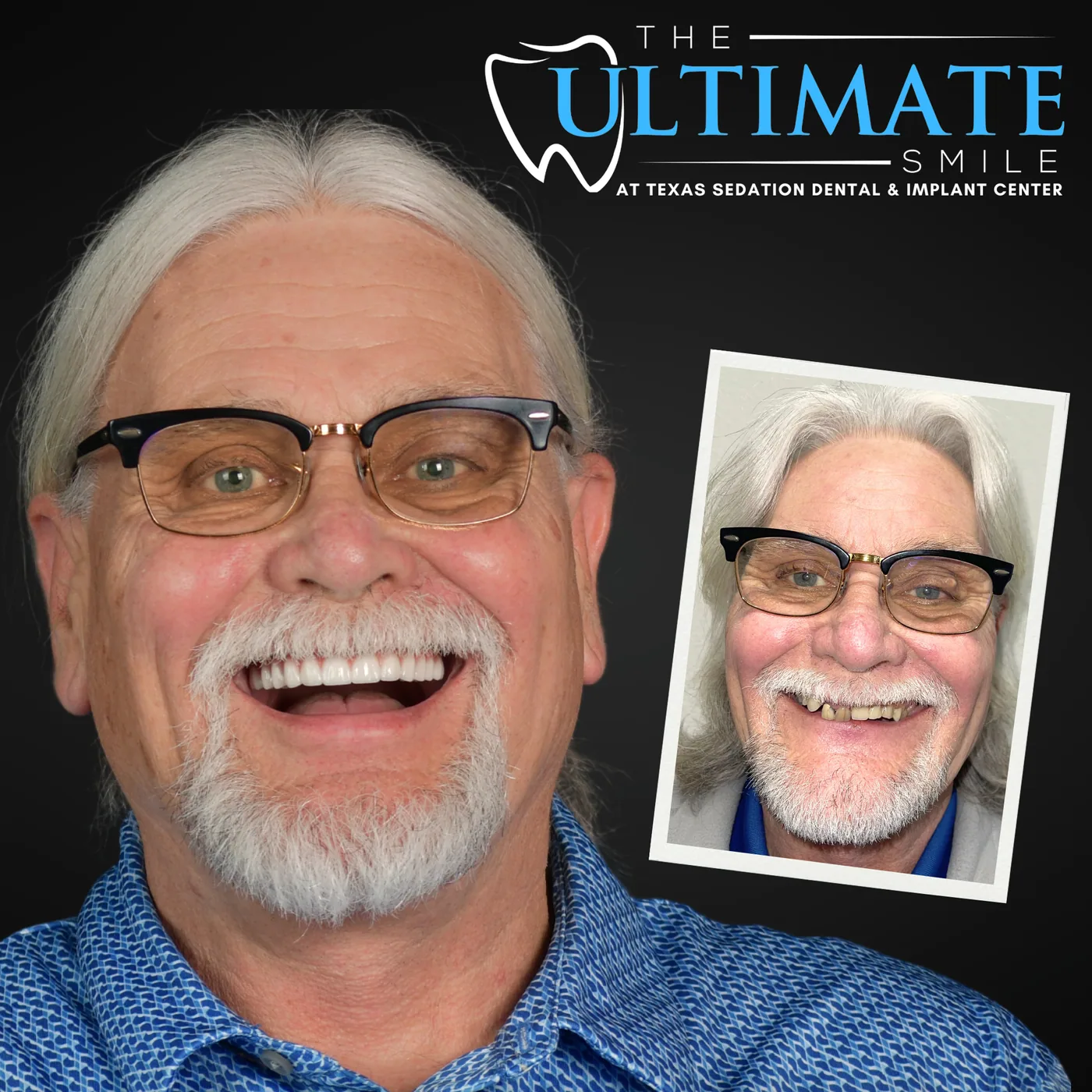 Patient before and after smile transformation