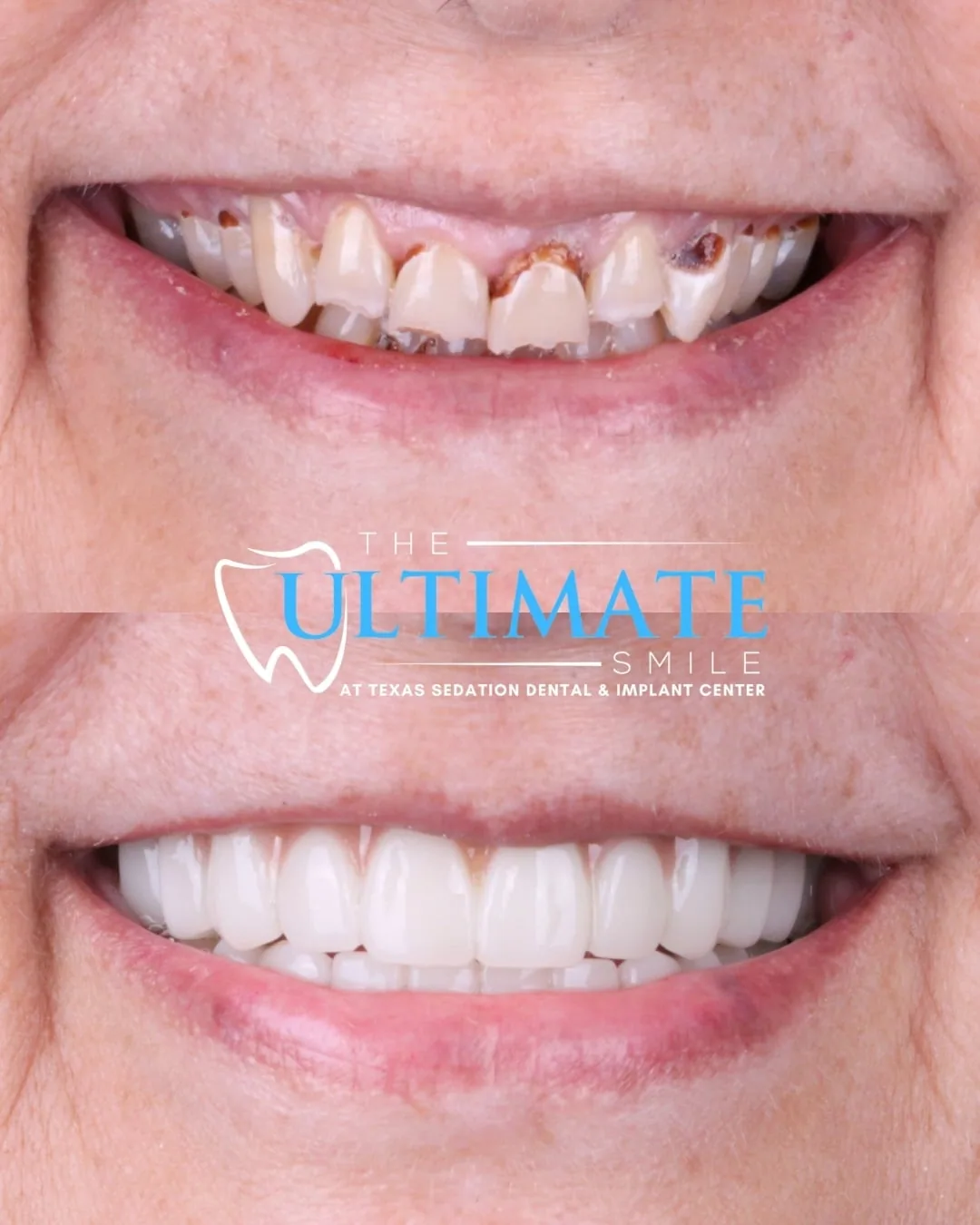 Patient before and after smile transformation