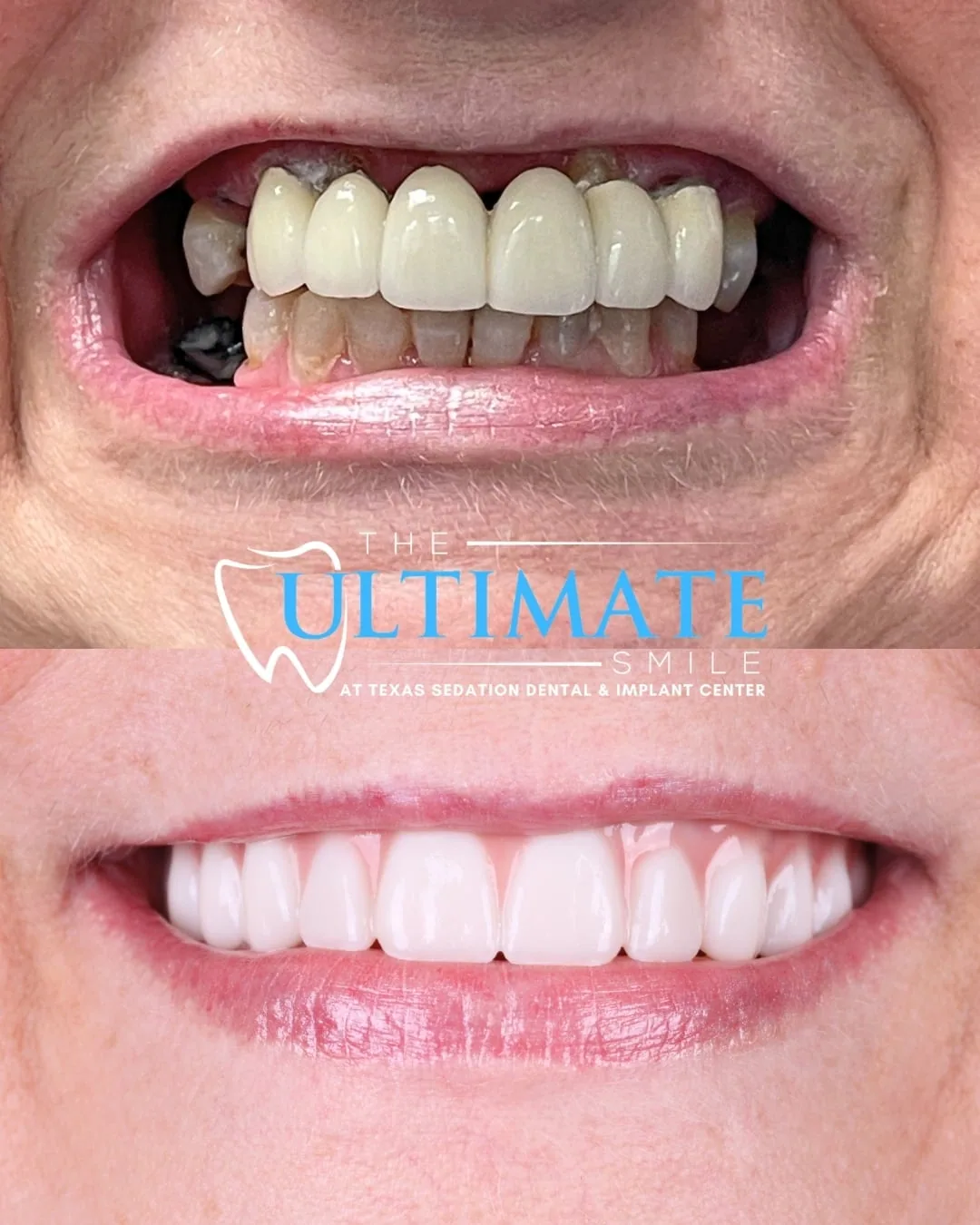 Patient before and after smile transformation