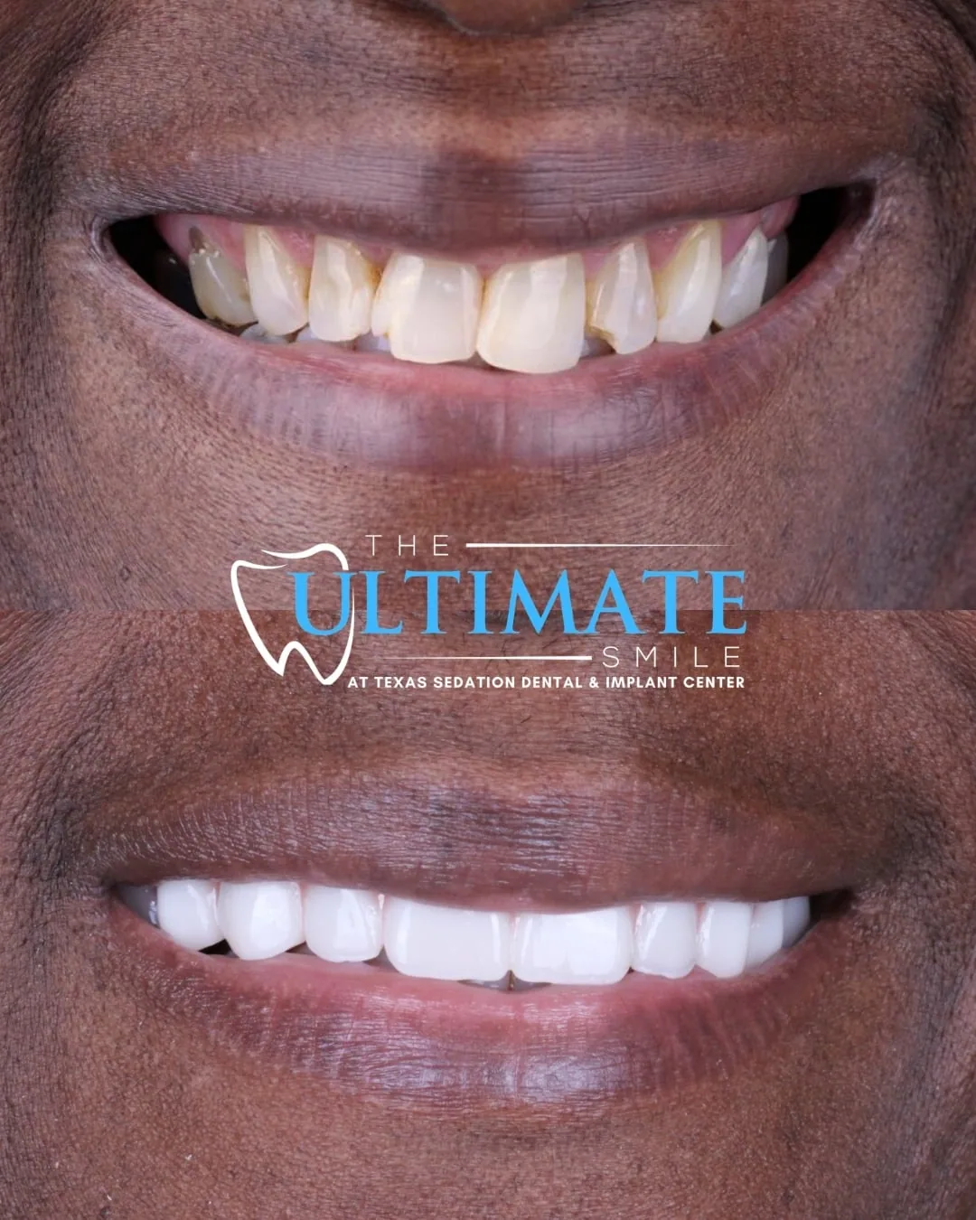 Patient before and after smile transformation