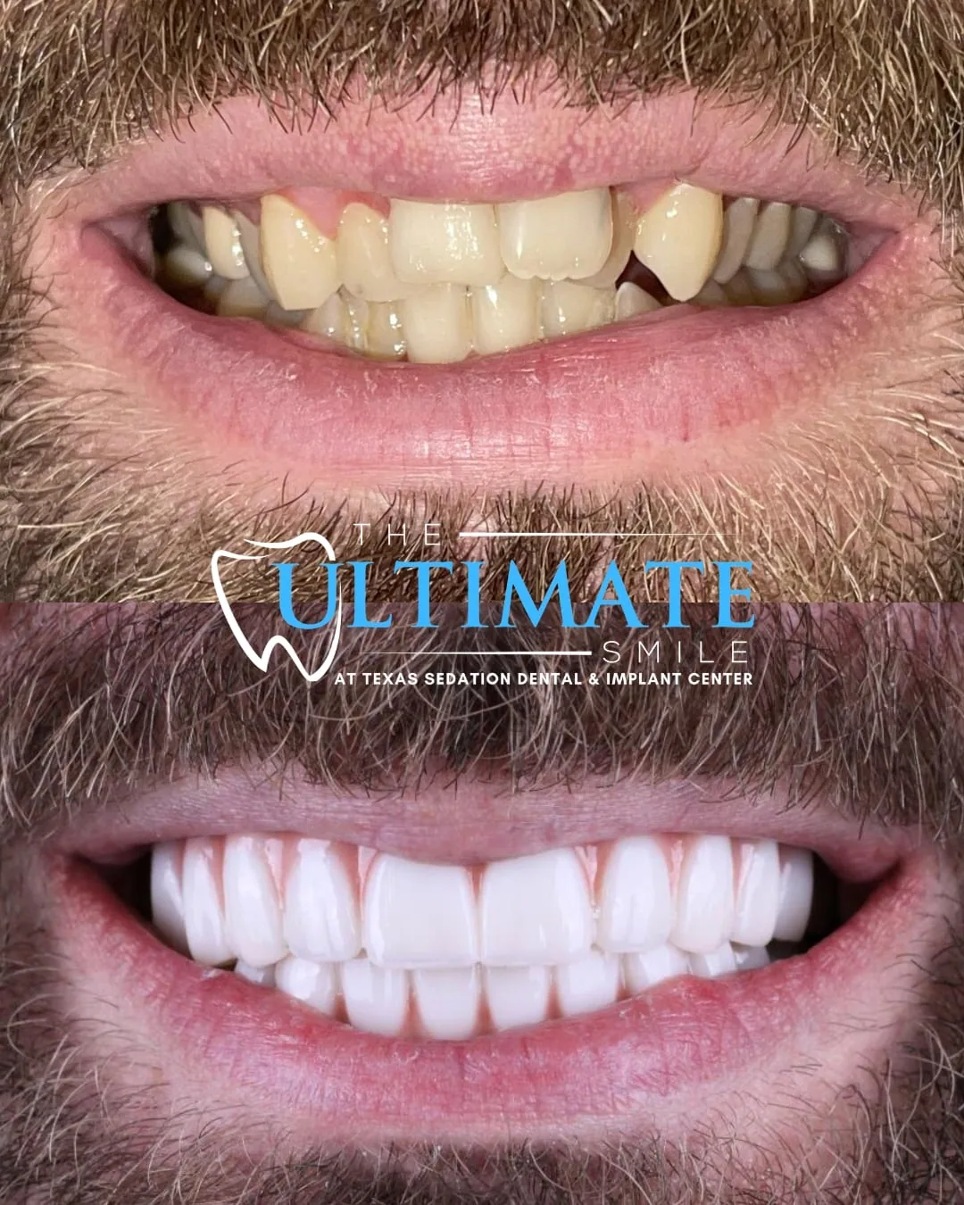 Patient before and after smile transformation