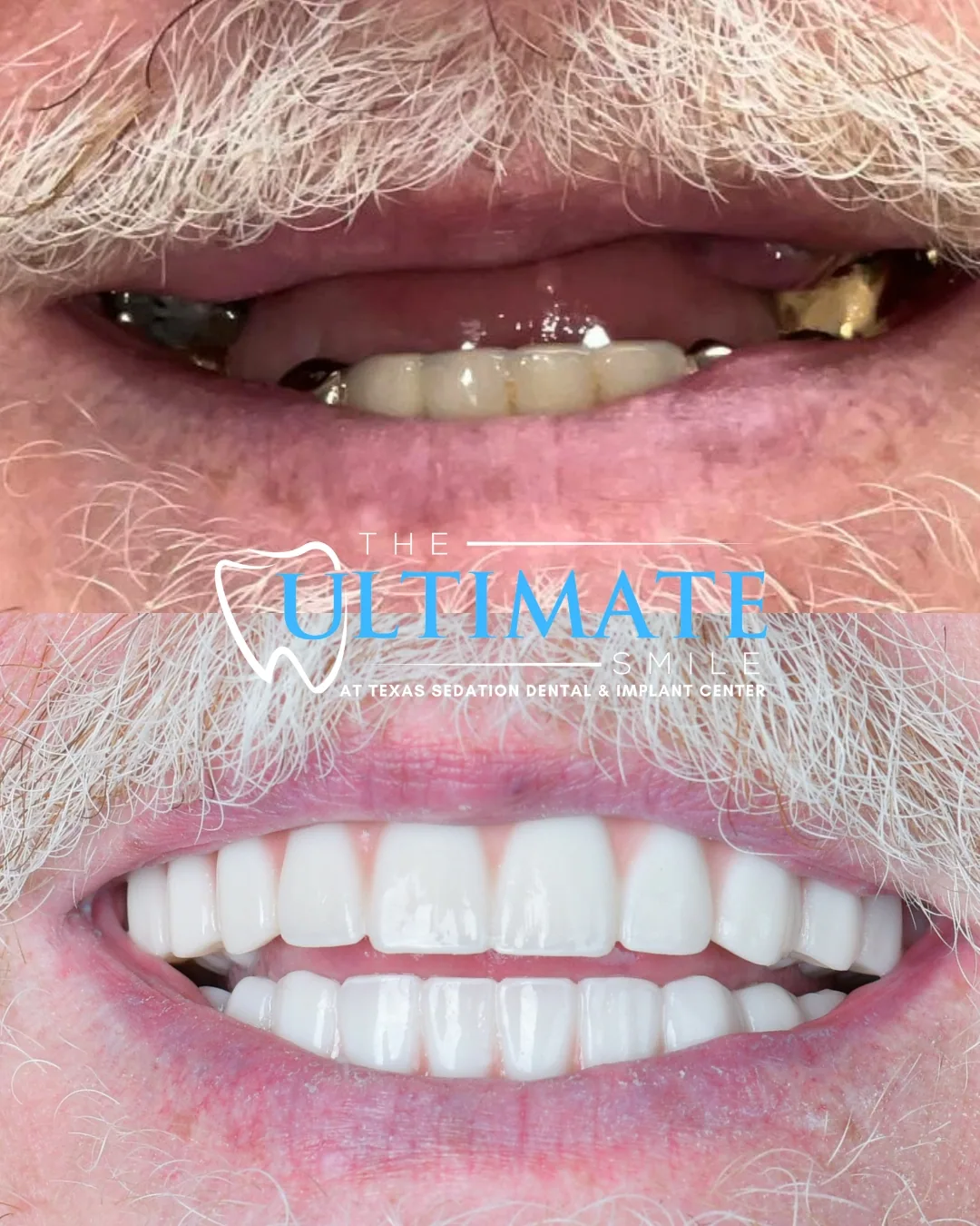 Patient before and after smile transformation