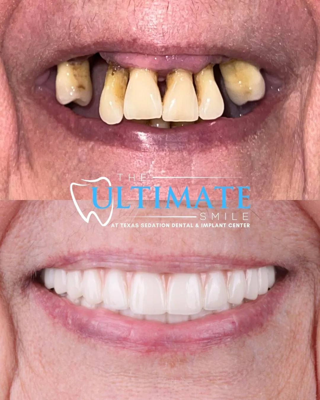 Patient before and after smile transformation