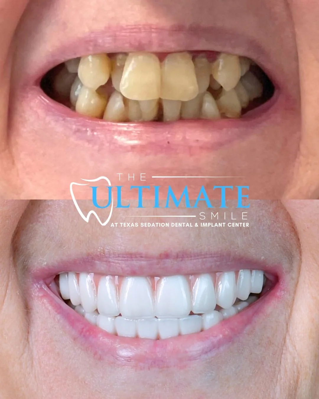 Patient before and after smile transformation