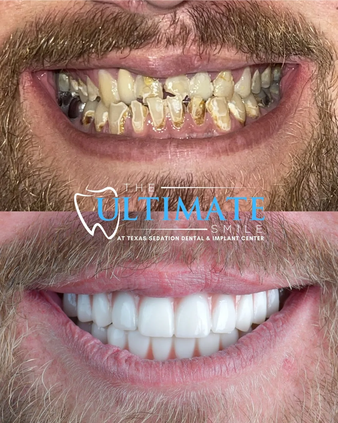Patient before and after smile transformation