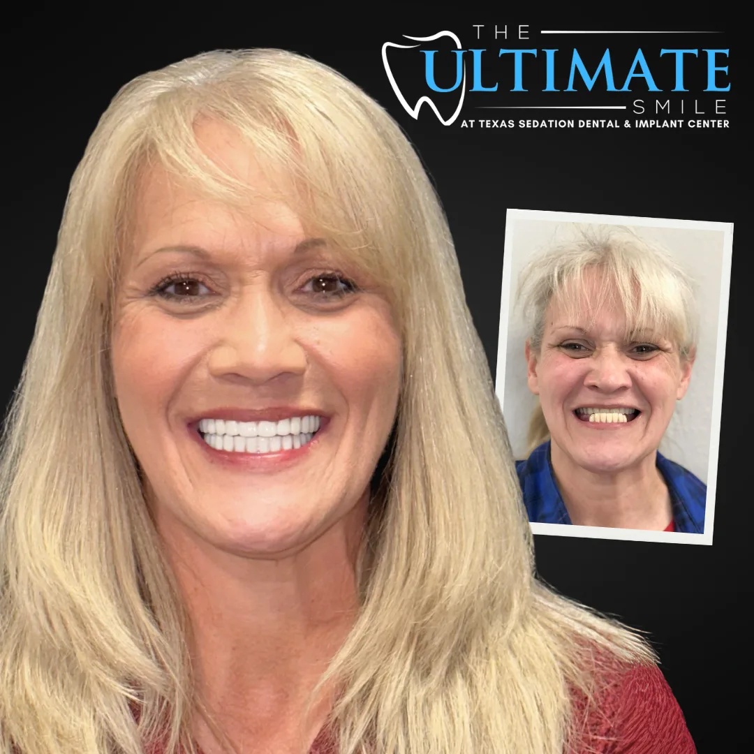 Before and after sedation dentistry smile makeover revealing brighter, straighter teeth