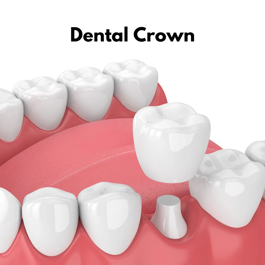 Illustration showing a dental crown placed over a prepared tooth to restore strength, shape, and appearance
