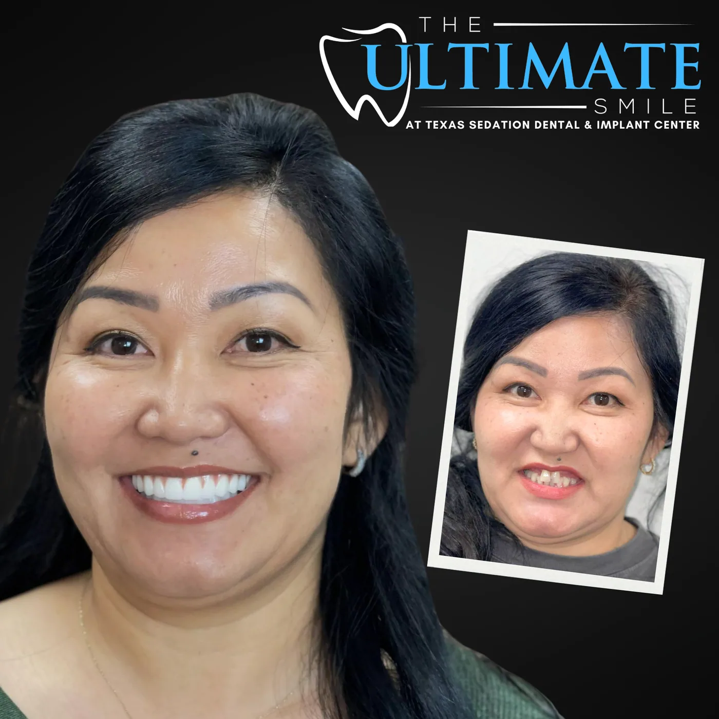 Patient before and after smile transformation
