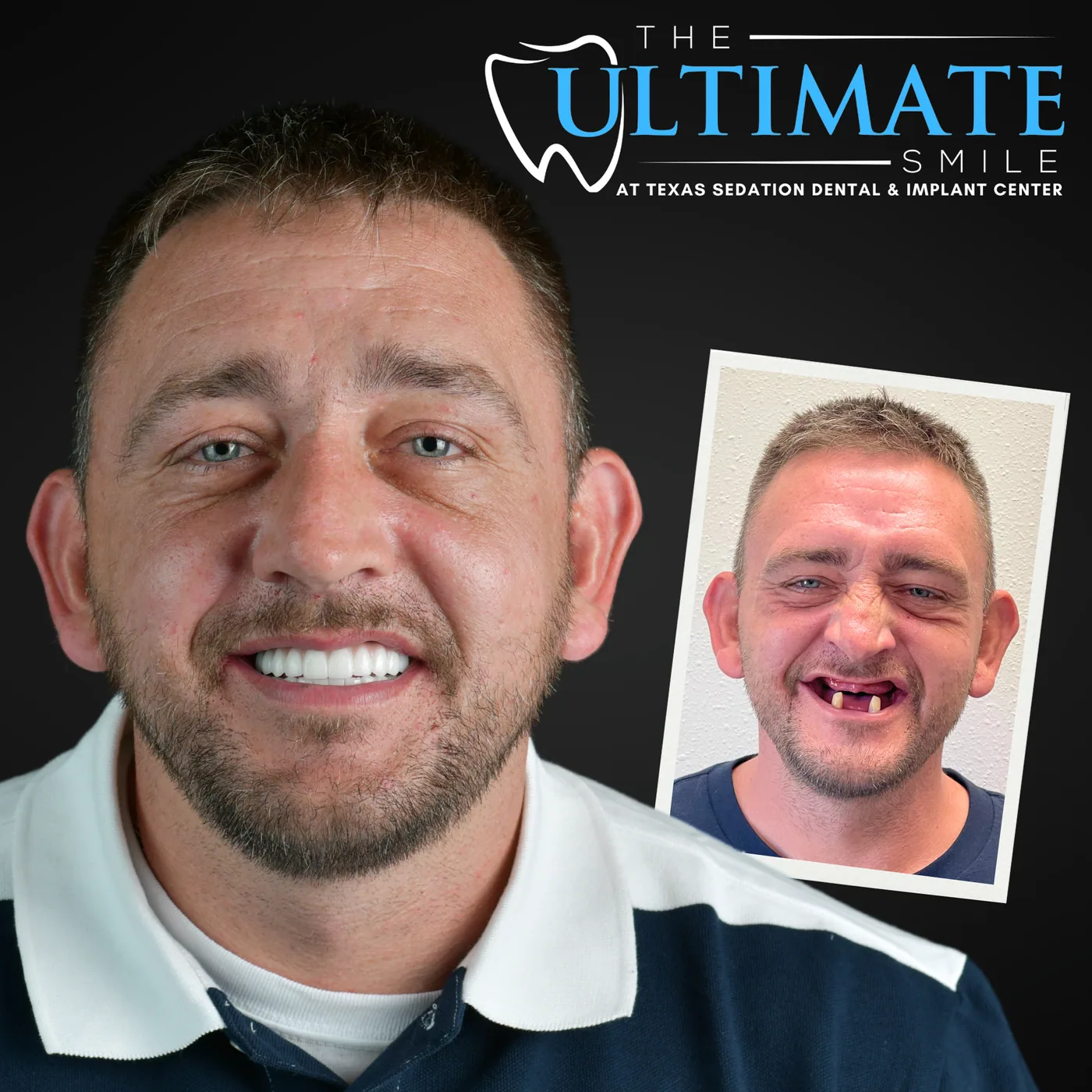 Patient before and after smile transformation