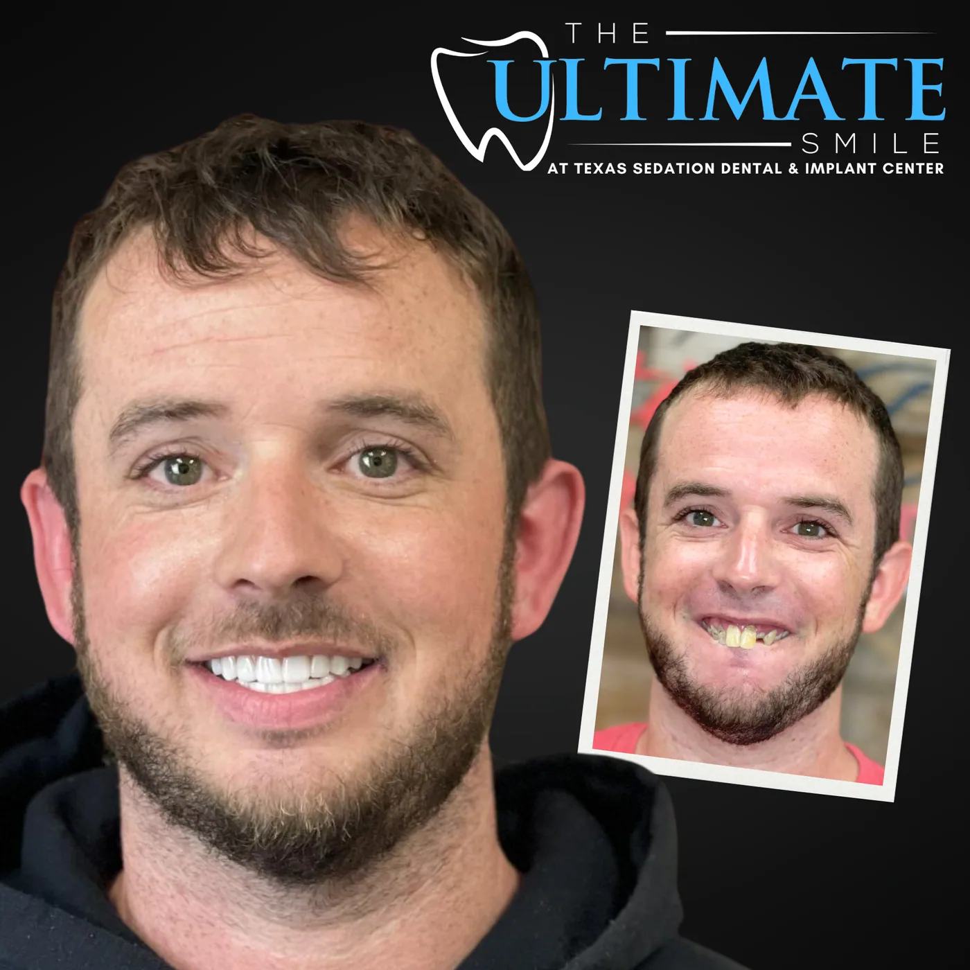 Patient before and after smile transformation
