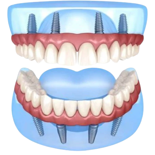 Fixed dental implants illustration