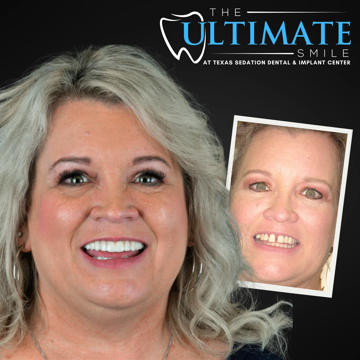 Patient before and after smile transformation