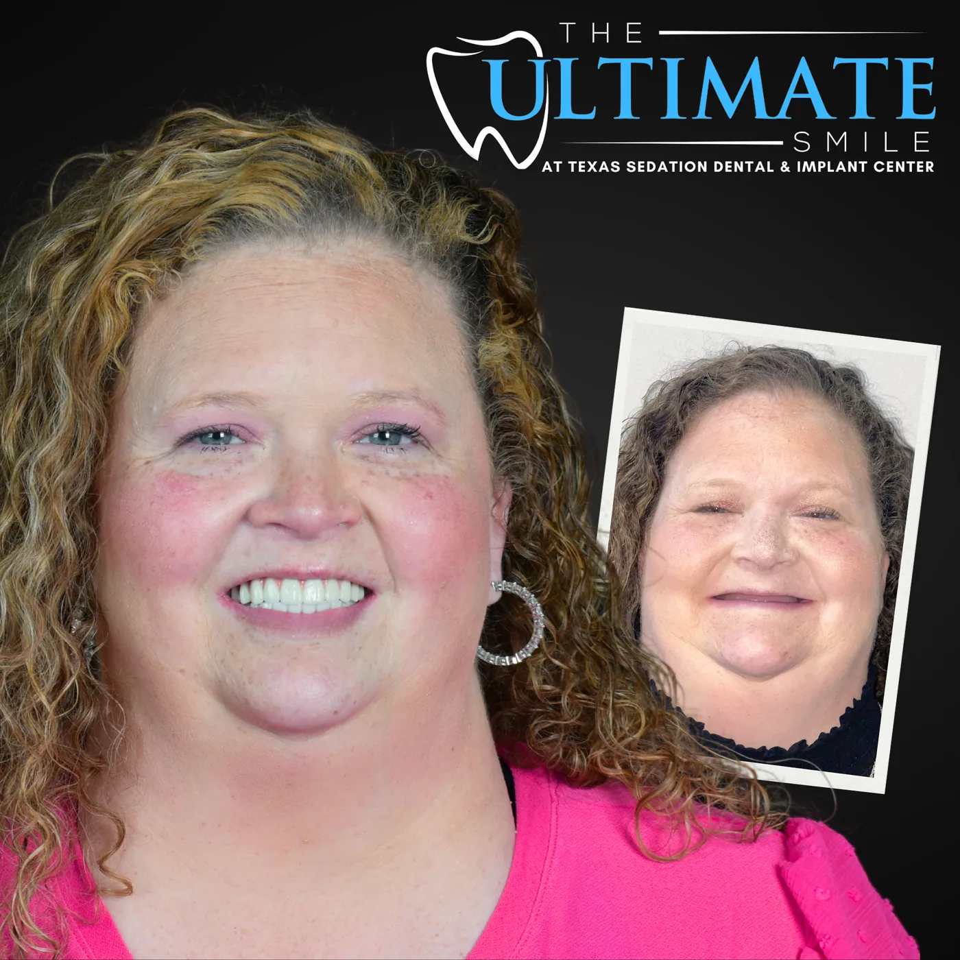 Patient before and after smile transformation