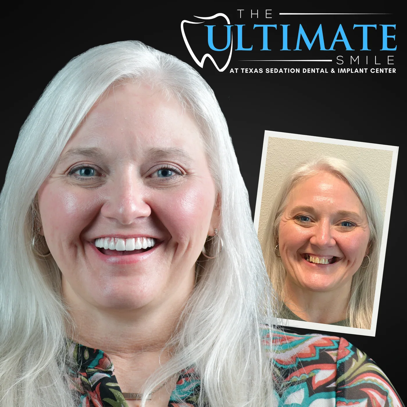 Patient before and after smile transformation