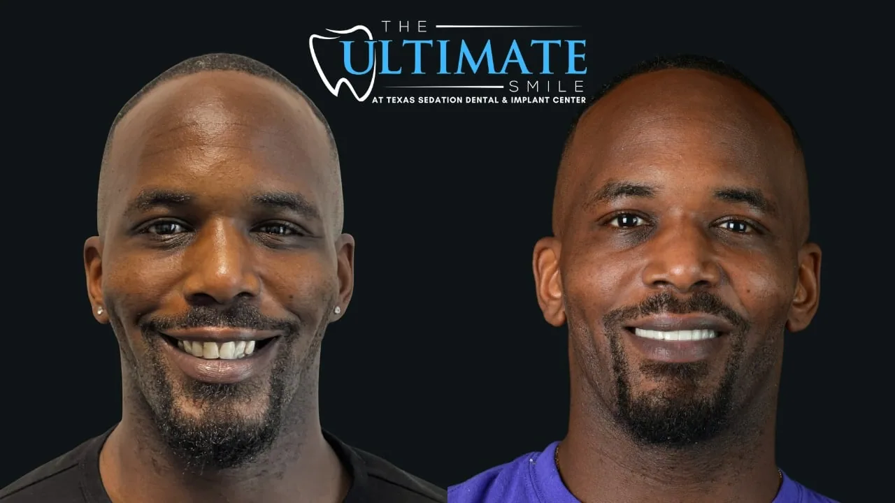Patient before and after, Ultimate Smile transformation
