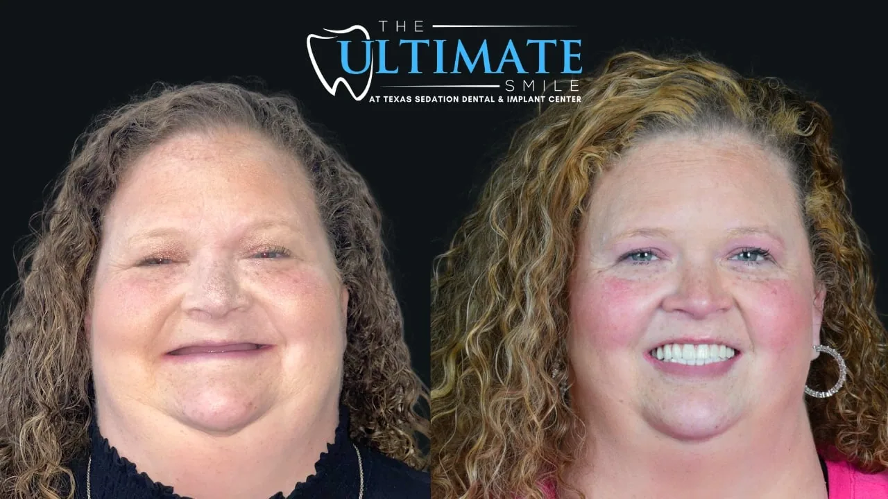 Patient before and after, Ultimate Smile transformation