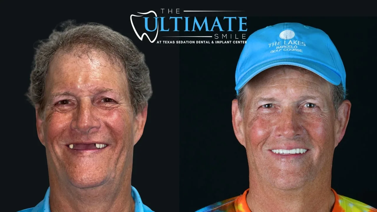 Patient before and after, Ultimate Smile transformation