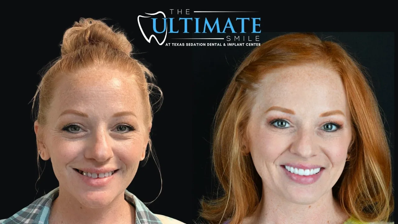 Patient before and after, Ultimate Smile transformation