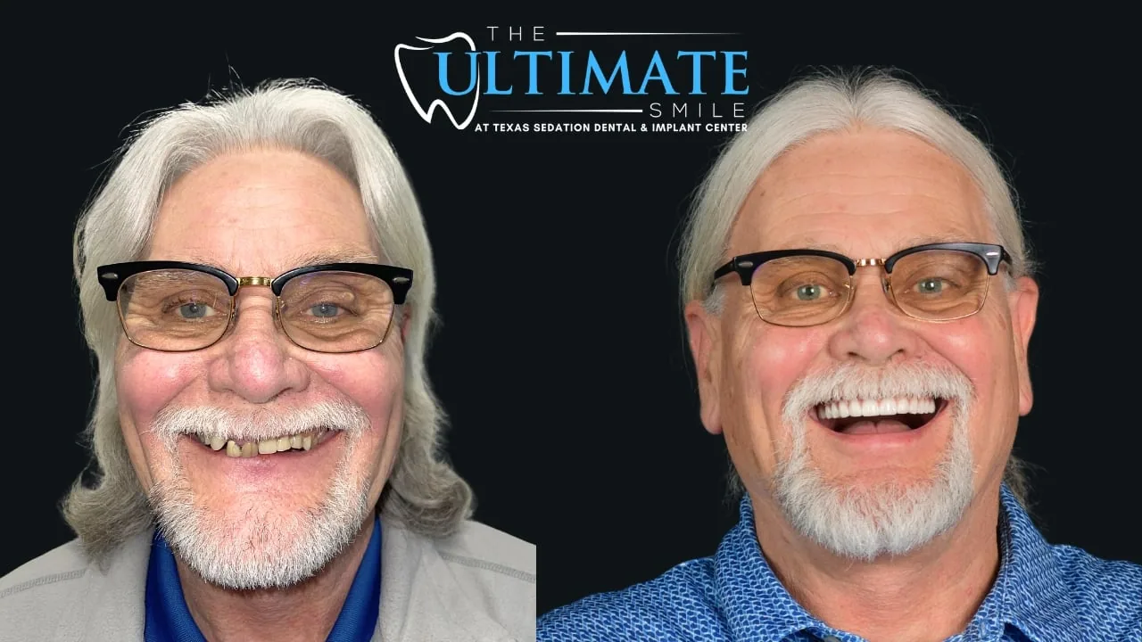 Patient before and after, Ultimate Smile transformation