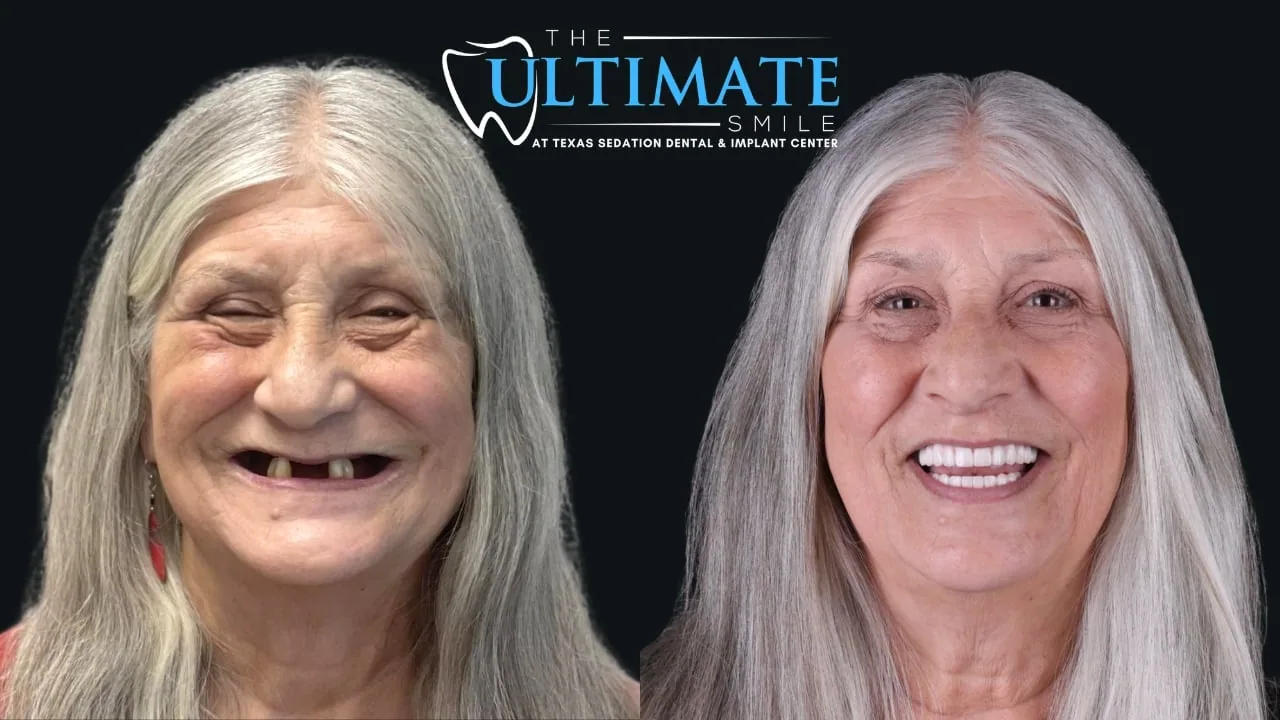 Patient before and after, Ultimate Smile transformation