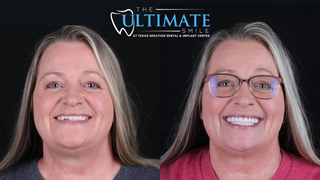 Patient before and after, Ultimate Smile transformation