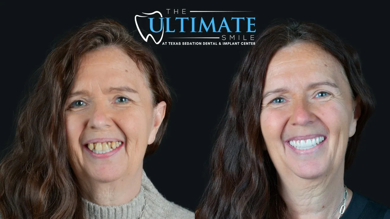 Patient before and after, Ultimate Smile transformation