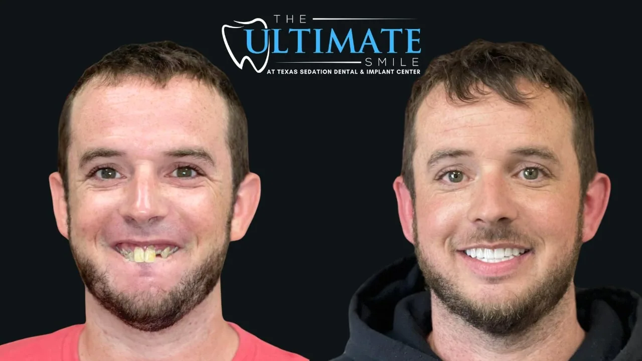Patient before and after, Ultimate Smile transformation