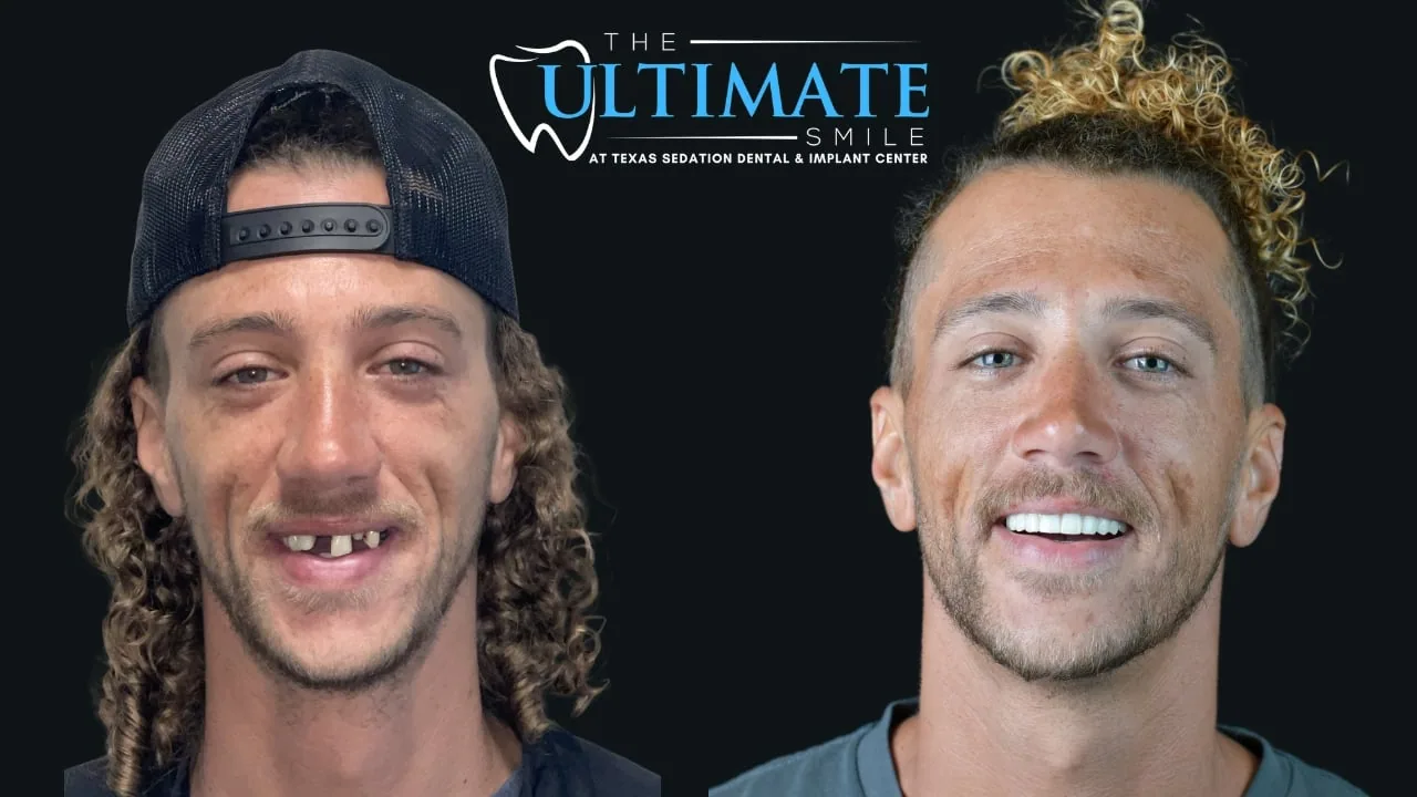 Patient before and after, Ultimate Smile transformation