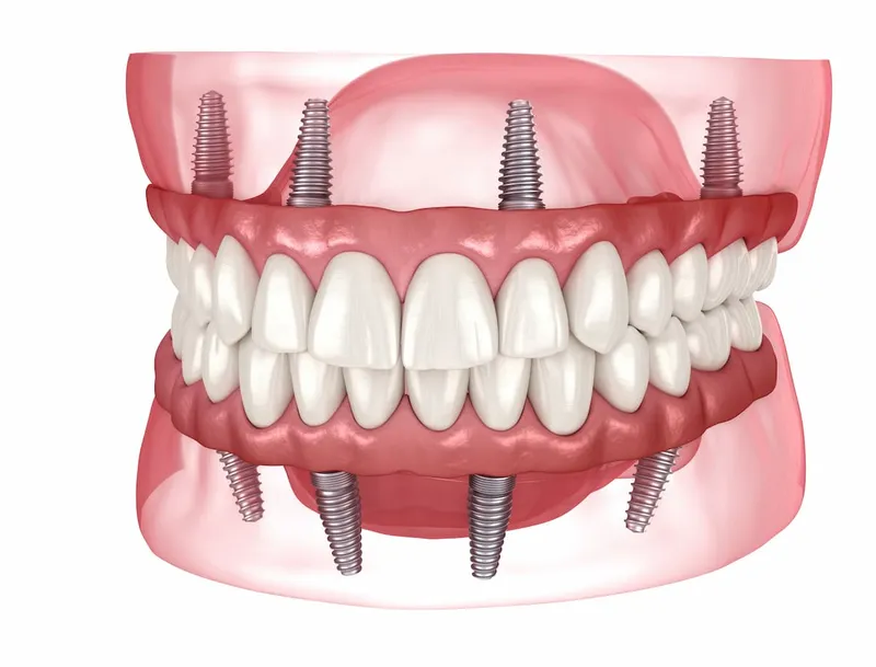 All on 4 Dental Implants service tile