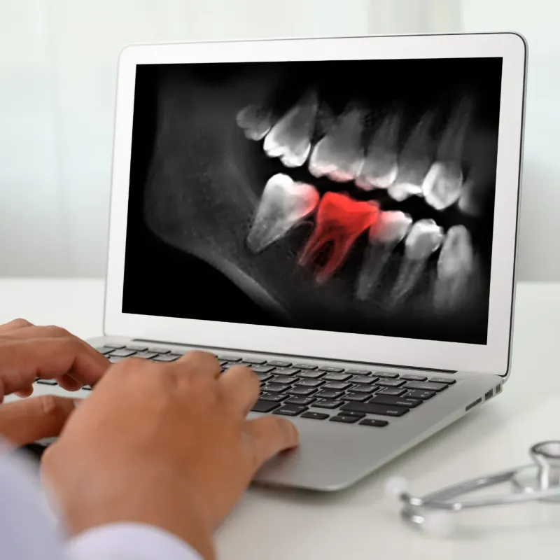 Root Canals service tile