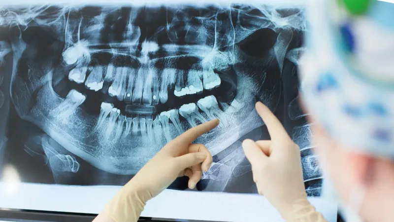 Tooth Extractions service tile