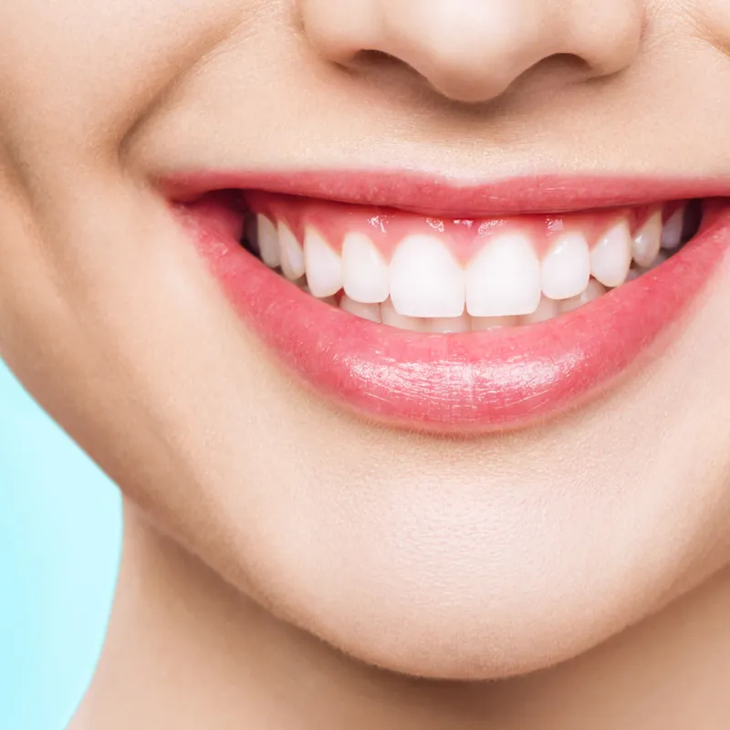 Veneers service tile